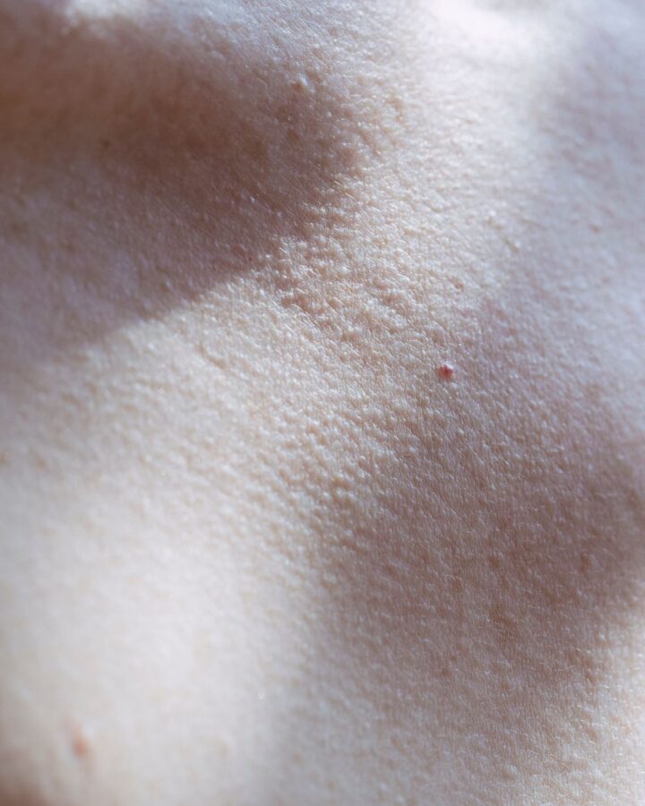 Textura de piel cuidada — intralipoterapia reductora